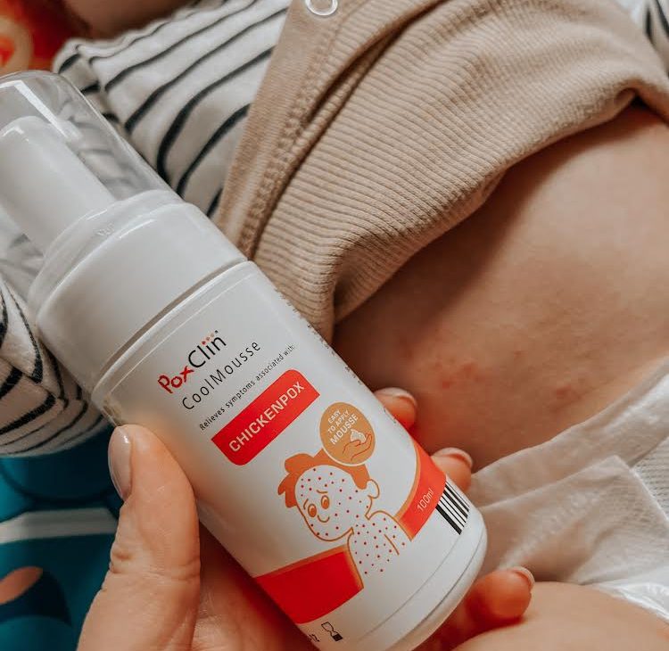 Chicken pox relief